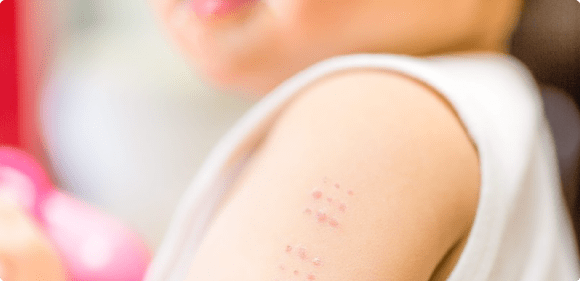 ハンコ注射の痕が付いた子供の腕の写真